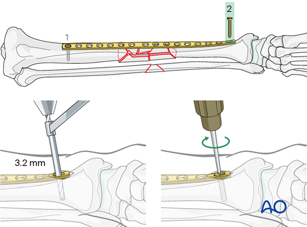 Bridge plating – Insertion of the second screw