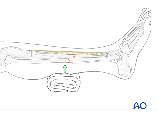 Bridge plating, Correcting sagittal displacement