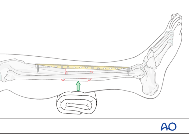 Bridge plating – Correcting sagittal displacement