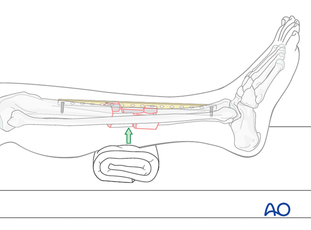 Bridge plating – Correcting sagittal displacement