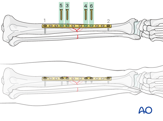 Bridge plating, Insertion of the remaining screws