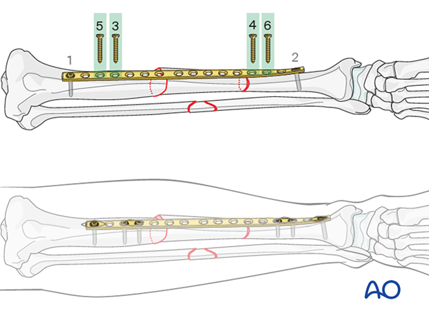Bridge plating – Insertion of the remaining screws