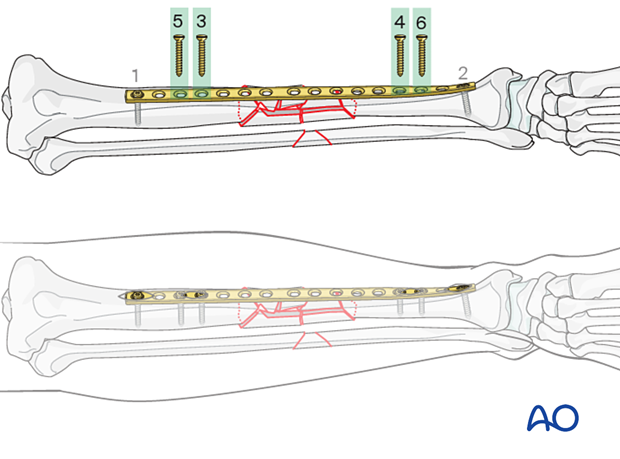 Bridge plating – Insertion of the remaining screws