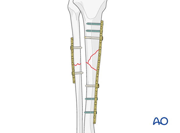 B2 tibial shaft fracture