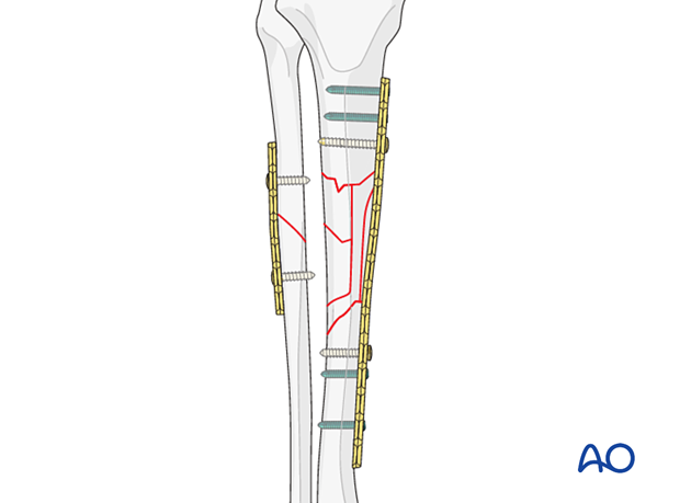 Bridge plating – Screws in locking plates
