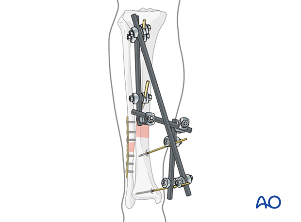 42_P030_i070 modular external fixator