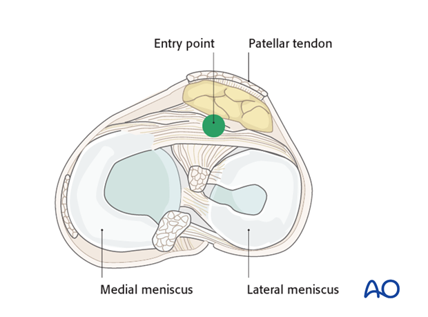 A Review of Proximal Tibia Entry Points for Intramedullary Nailing