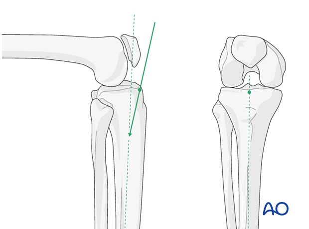 nailing limited open approach to the distal tibia