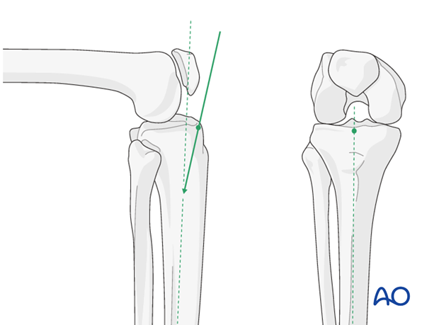 A Review of Proximal Tibia Entry Points for Intramedullary Nailing