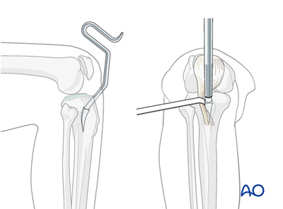 MIO - Intramedullary nail for Extraarticular, simple fracture