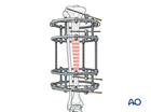 Tibial shaft fracture: ring fixator