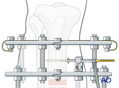 Ring fixation for Simple fracture, spiral