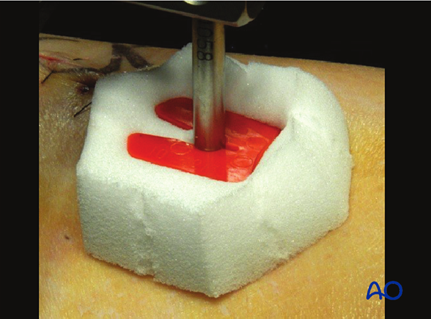 42_P050_Main_i765 Compressive dressing