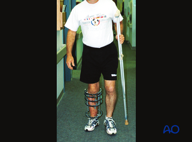 42_P050_Main_i840 Patient with ring fixator observed ambulating