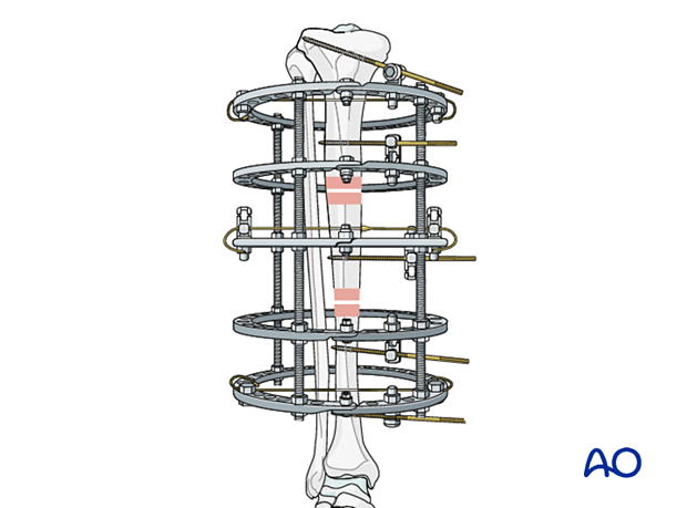 42_P050C2_Intact_Segmental_i020