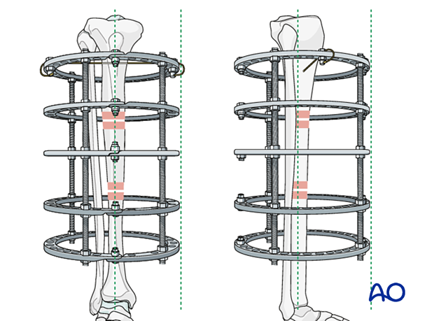 42_P050C2_Intact_Segmental_i320