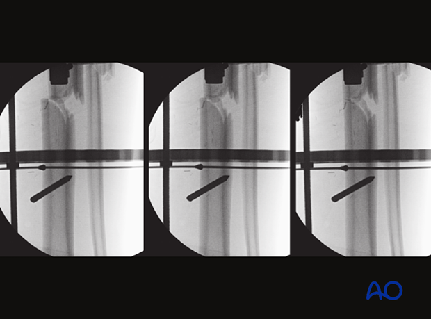 Ring fixation – intact segmental tibia, positioning wire