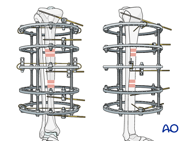 42_P050C2_Intact_Segmental_i440