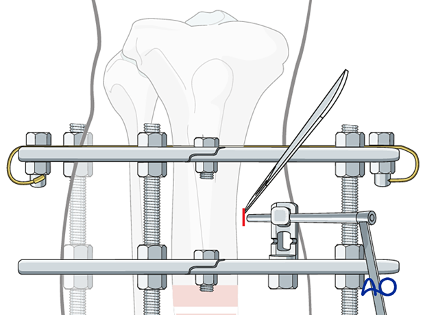 42_P050C2_Intact_Segmental_i520
