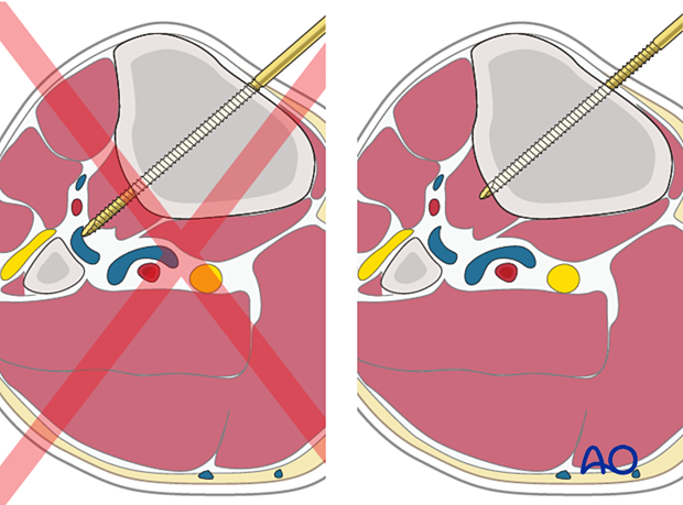 42_P050C2_Intact_Segmental_i620 42_P050C2_i620