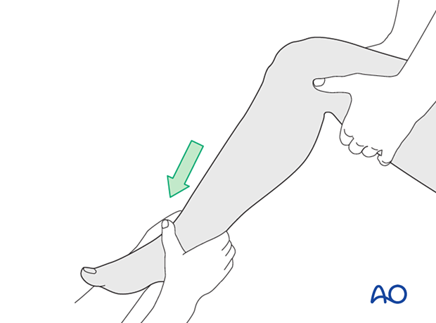 42_P060_i020 uniplanar external fixator, Reduction