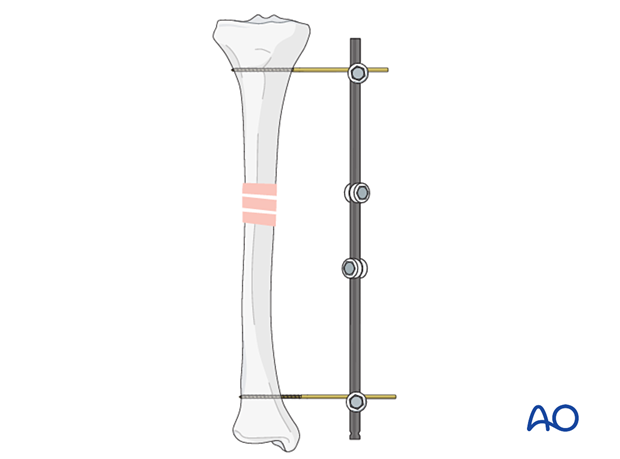 42_P060_i030 uniplanar external fixator, Pin insertion and frame assembly