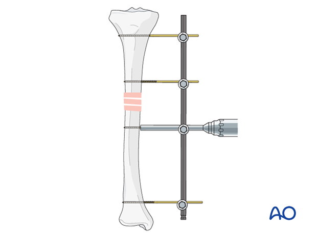 42_P060_i040 uniplanar external fixator, Pin insertion and frame assembly