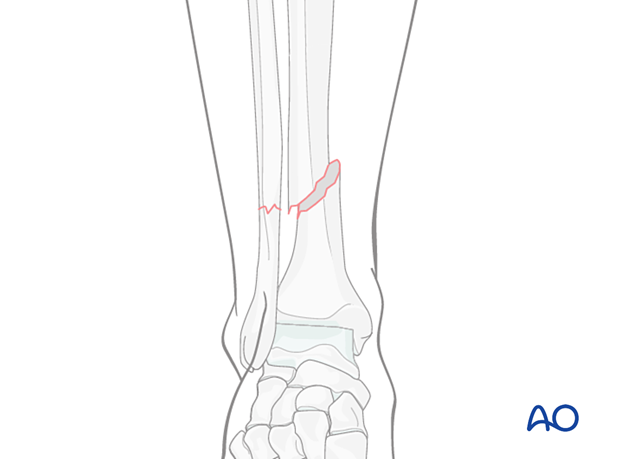 A2 tibial shaft fracture