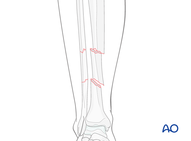 C2 tibial shaft fracture