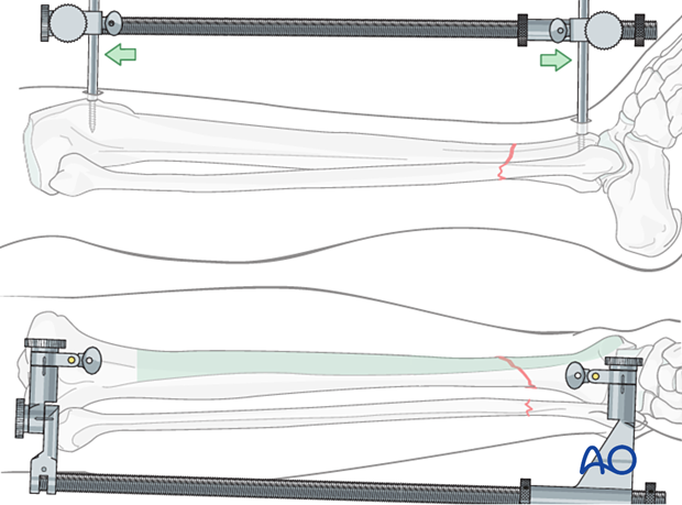 A2 tibial shaft fracture - If manual traction is unsuccessful, use a large distractor for closed reduction.
