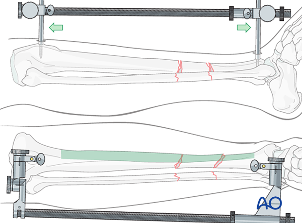 C2 tibial shaft fracture: Use a large distractor for closed reduction.