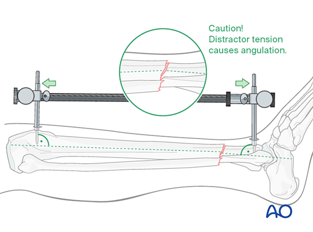 A2 tibial shaft fracture - With significant tension of the distractor, the fracture may angulate, with concavity on the side opposite to the distractor.