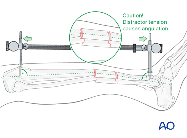 C2 tibial shaft fracture: With significant tension of the distractor, the fracture may angulate, with concavity on the side opposite the distractor.
