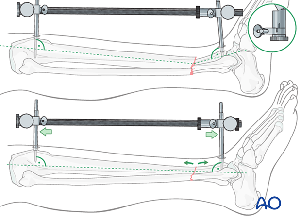 A2 tibial shaft fracture - The distractor or external fixator pins can be adjusted to correct the angular deformity.