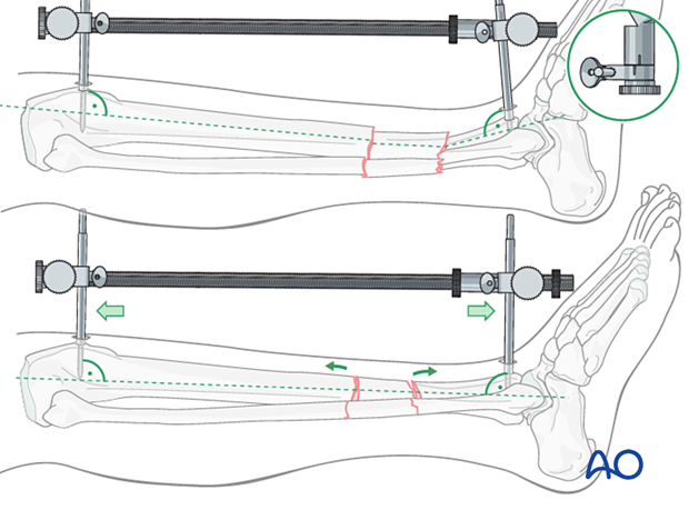 C2 tibial shaft fracture: The distractor or external fixator pins can be adjusted to correct the angular deformity.