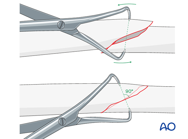 A2 tibial shaft fracture - When possible, reduction forceps are a valuable aid.