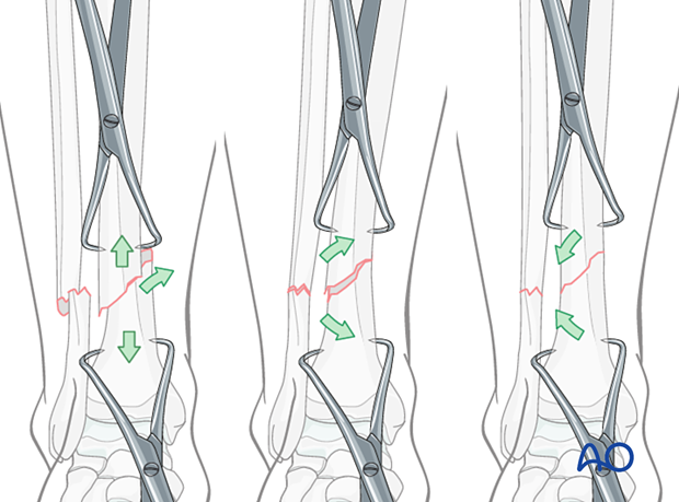 A2 tibial shaft fracture - With transverse fractures, the forceps cannot be applied to compress the fracture surfaces