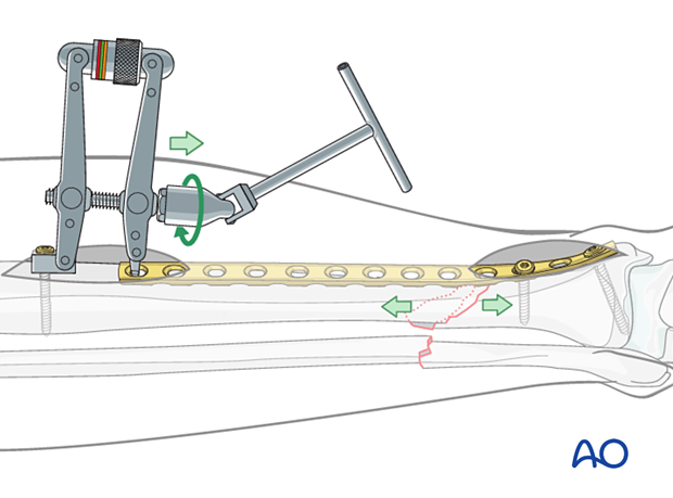 A2 tibial shaft fracture - To use the ATD, in distraction mode, a precontoured plate is applied to one of the main fracture fragments.