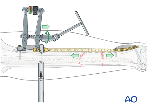 C2 tibial shaft fracture: To use the ATD in distraction mode, a precontoured plate is applied to one of the main fracture fragments.