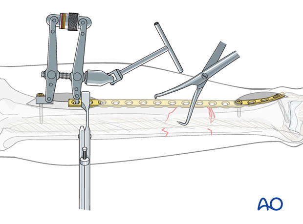 C2 tibial shaft fracture: the proximal, short oblique fracture has been anatomically reduced and provisionally fixed.