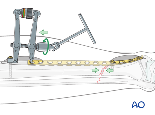 A2 tibial shaft fracture - With the fracture satisfactorily reduced, the ATD is used in compression mode