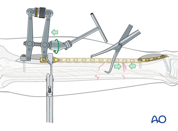 C2 tibial shaft fracture: With the proximal fracture provisionally fixed with the pointed reduction forceps, the transverse fracture may be reduced...