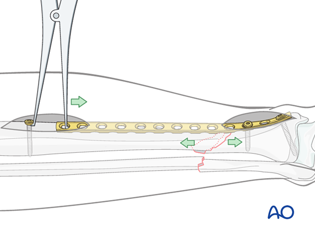 A2 tibial shaft fracture - A precontoured plate is applied to one of the main fragments