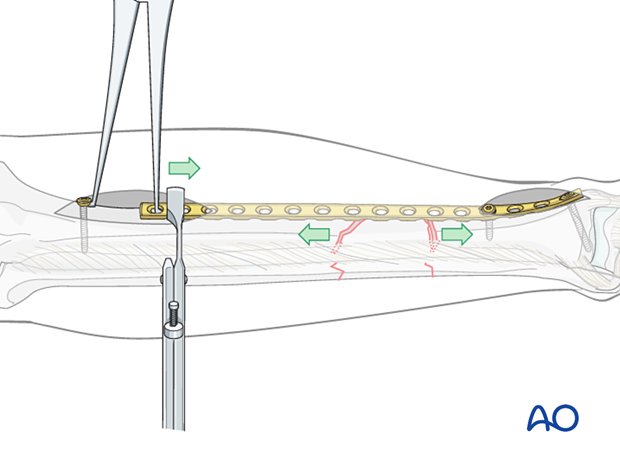 C2 tibial shaft fracture: A precontoured plate is applied to one of the main fragments.