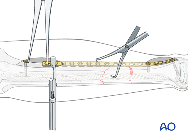 C2 tibial shaft fracture: with the length restored, the short oblique fracture can be reduced anatomically with the pointed reduction forceps.