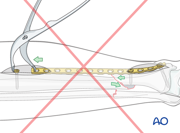 A2 tibial shaft fracture - Remember that compression plating of an oblique fracture requires creation of an “axilla”