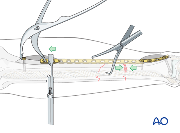 C2 tibial shaft fracture: with the proximal fracture clamped, the transverse fracture may be reduced and compressed using a Verbrugge clamp