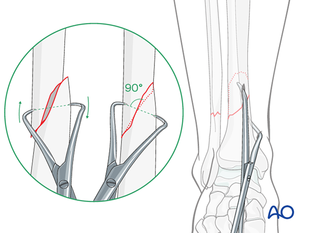 A2 tibial shaft fracture - Final reduction of the fracture is done with pointed reduction forceps placed through two stab incisions.