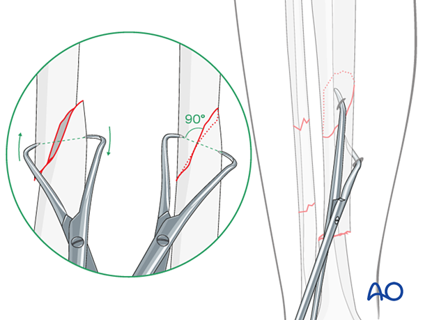C2 tibial shaft fracture: Final reduction may be possible with percutaneously applied pointed reduction forceps.