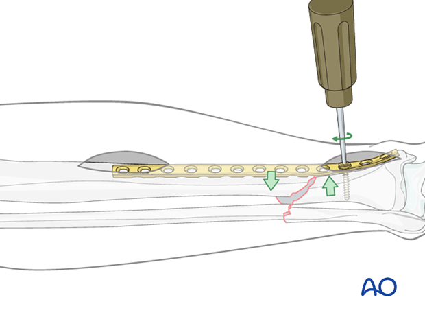 A2 tibial shaft fracture - Reduction can also be achieved by reducing the fracture to the plate.